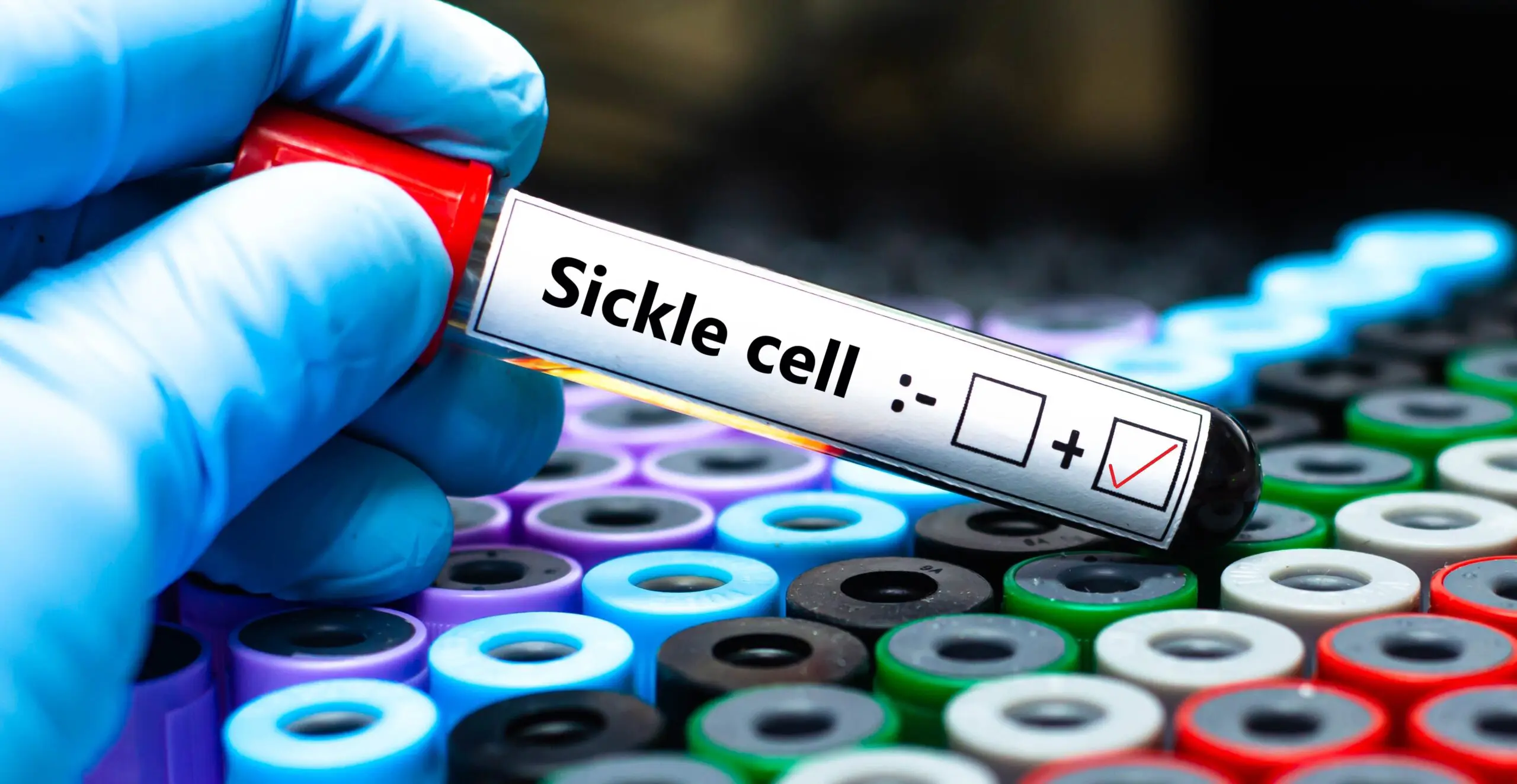 Blood sampling tube Blood sample of patient positive
tested for sickle cell.