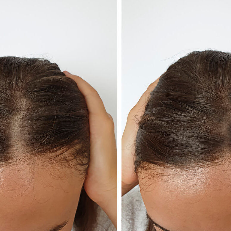 HairLossBeforeAfterC