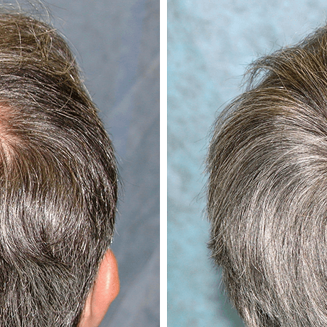 beforeafter_crown_spi-1